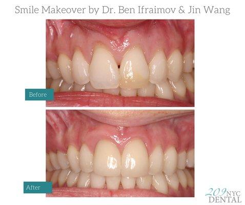 Cosmetic Dental Treatment by Dr. Ben Ifraimov