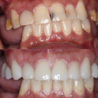 Before and After Porcelain Crowns