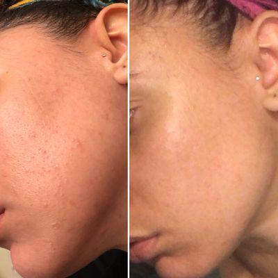 Signature Peel- before and after results