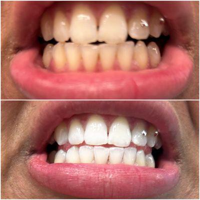 1 session of teeth whitening