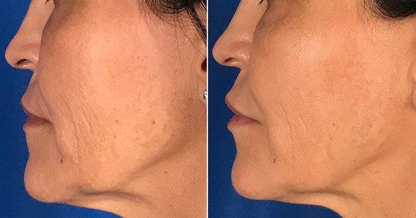 Restylane Defyne results in the lips, cheek, and nasolabial folds.