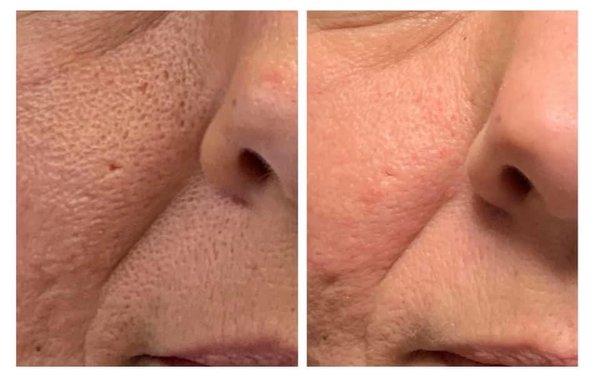 Microneedling Reduces the size of the signs pores. (Results after 4 treatments)