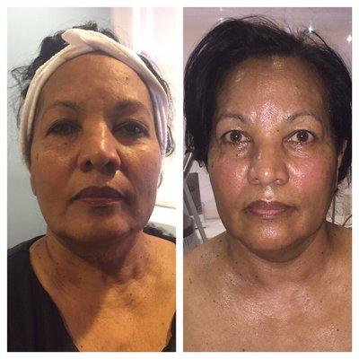 After 6 Venus face skin tightening treatments .