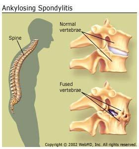 ankylosing spondylitis sucks it hurts. And there's no cure. Thanks Bentley's hurt. Putting me through more pain.