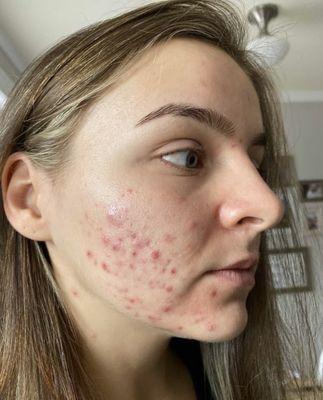 Adult acne with which I came to Enigma