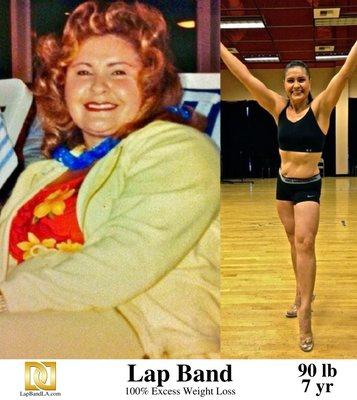 Lap Band Los Angeles Before and After by bariatric surgeon Dr. Davtyan