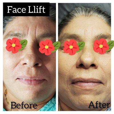 Face Lift facial after 3 sessions