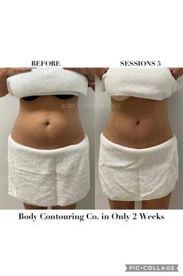 Body Contouring