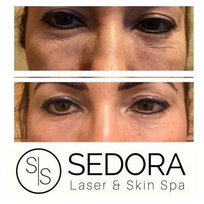 Microneedling to reduce dark circles, acne scars, and fine lines.