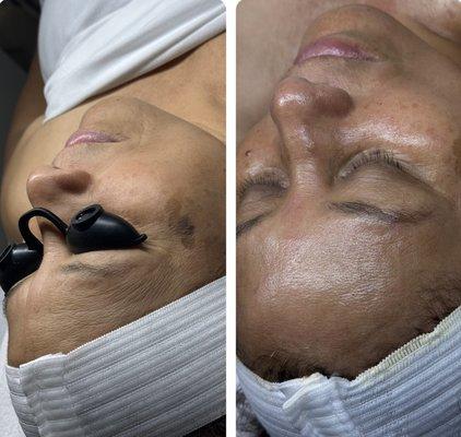 Anti-aging Facial