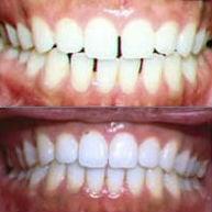 Invisalign: Before and After 2