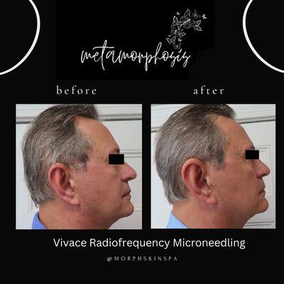 Results after one Vivace radiofrequency microneedling!  Improved tone and texture, and reduced fine lines.