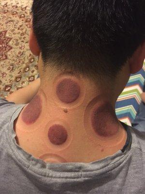 cupping for nick