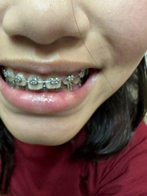 After she has braces for almost 2 years now and nothing change but it got worse.