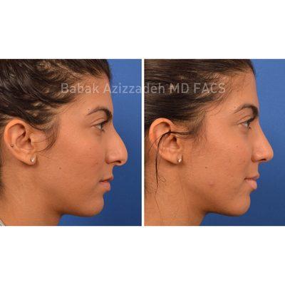 Best rhinoplasty before & after