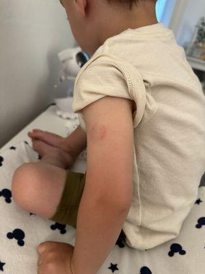 Bite mark on my two year old from child care