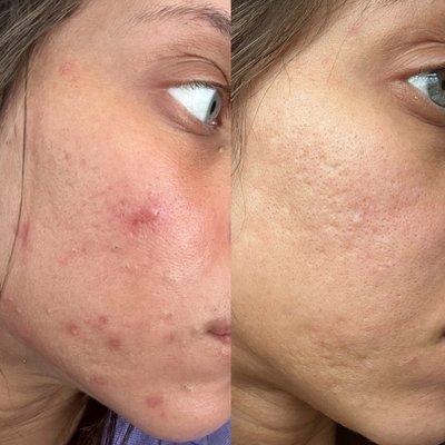 3 months customized  treatments