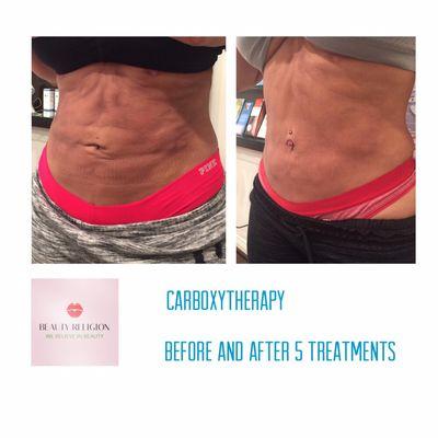 This Patient got uneven skin after liposuction. Five Carboxytherapy treatments were performed to smooth the dimples.