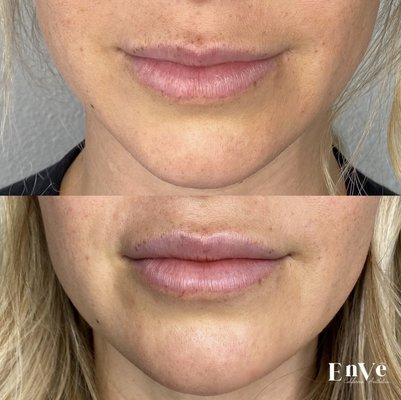 Lip Flip with Botox - 4 Units to give the upper lip some fullness