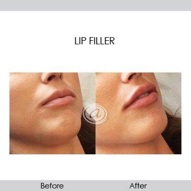 Lip filler