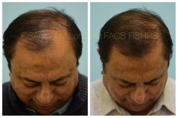 Lam Institute for Hair Restoration