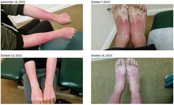 My Psoriasis Progress with Dr. Kelly