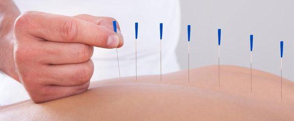 Dry Needling