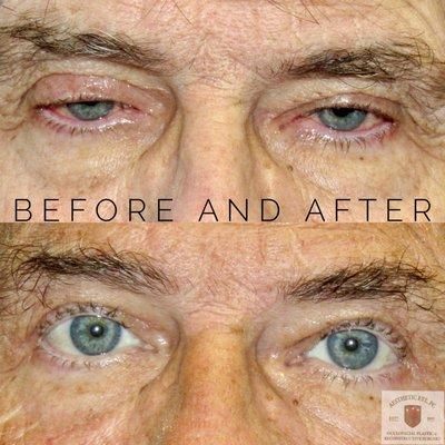 Bilateral Upper Lid Ptosis and Blepharoplasty