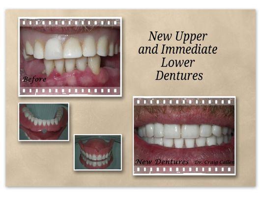 Replacement of old upper denture and immediate lower