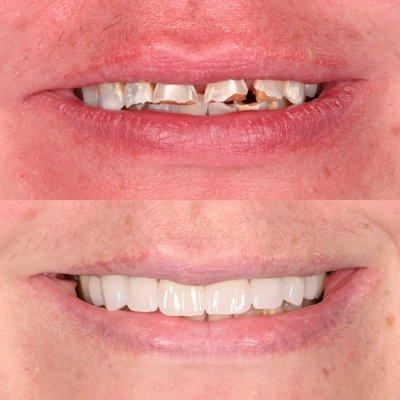 8 beautiful porcelain veneers creating an anti-aging effect , to restore broken and worn down teeth