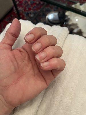 Damage to natural nails