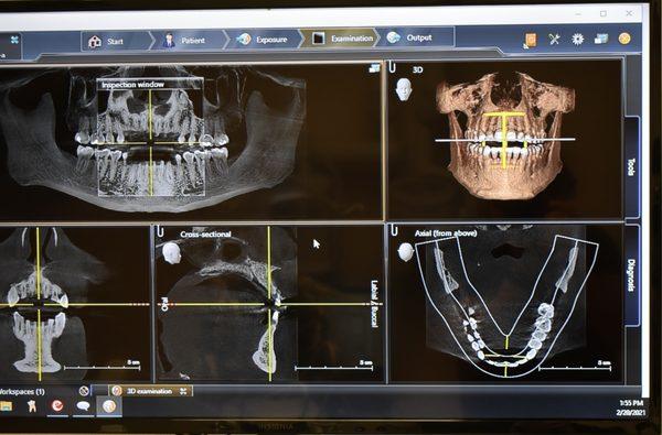 3D Dental imaging for minimally invasive guided implant surgery