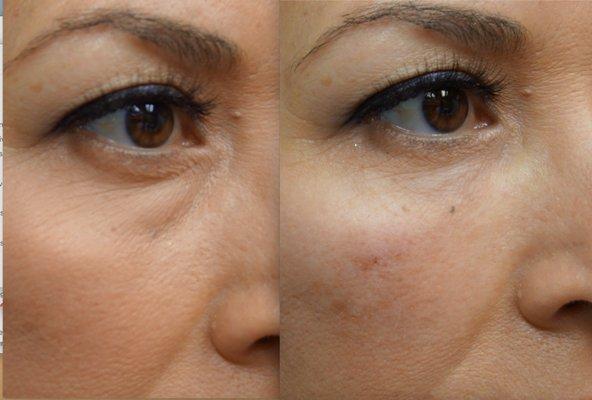 Before and After Lower Eyelid Filler - Non-Surgical