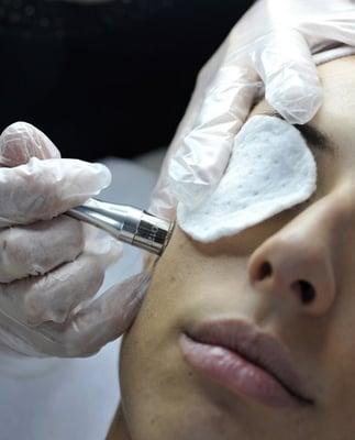 Diamond-Microdermabrasion