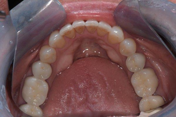 Invisalign after. ( Dentistry performed by Dr. Sullivan)