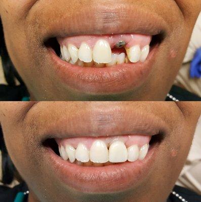 Dental Implants Correct Missing and Broken Teeth.