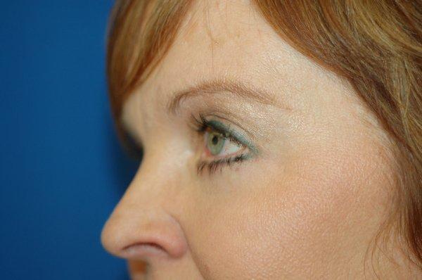 Austin Cosmetic Surgery Procedure - Eyelid Lift/Blepharoplasty After Image (Patient 2)