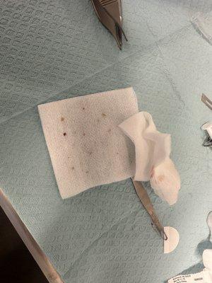 Skin tag removal