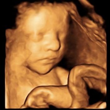 2D / 3D Ultrasound - B.B. Precious Ultrasound Imagery Studio, Gender Determination