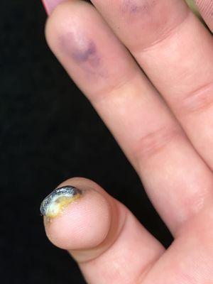 Lifted nail due to stylist filing down too far and infected