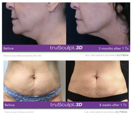 Trusculpt 3D