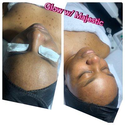 Microdermabrasion facial