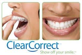 Braces? Why not Clear Correct! Ask For Details.