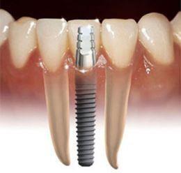 Dental implant