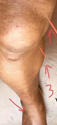 Acupuncture 3 needles to improve knee problem