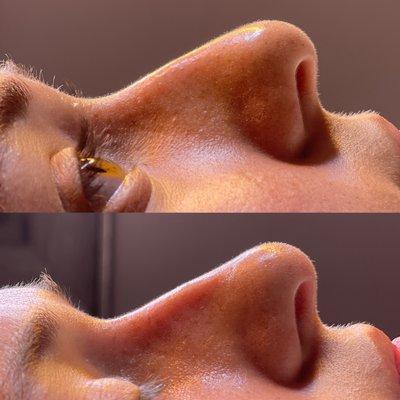 Non-Surgical Nose Job with Filler