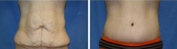 Tummy Tuck Before & After