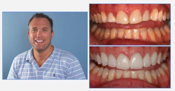 Emil - Eight veneer smile makeover!