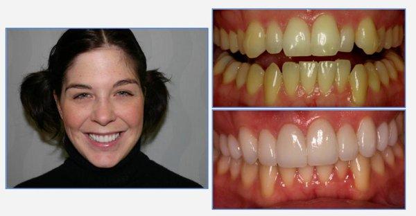 Emily - Ten veneers to straighten teeth!