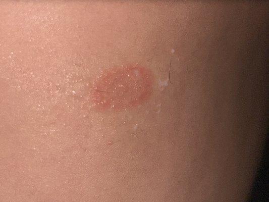 Ringworm from the kittens you sold to my mom